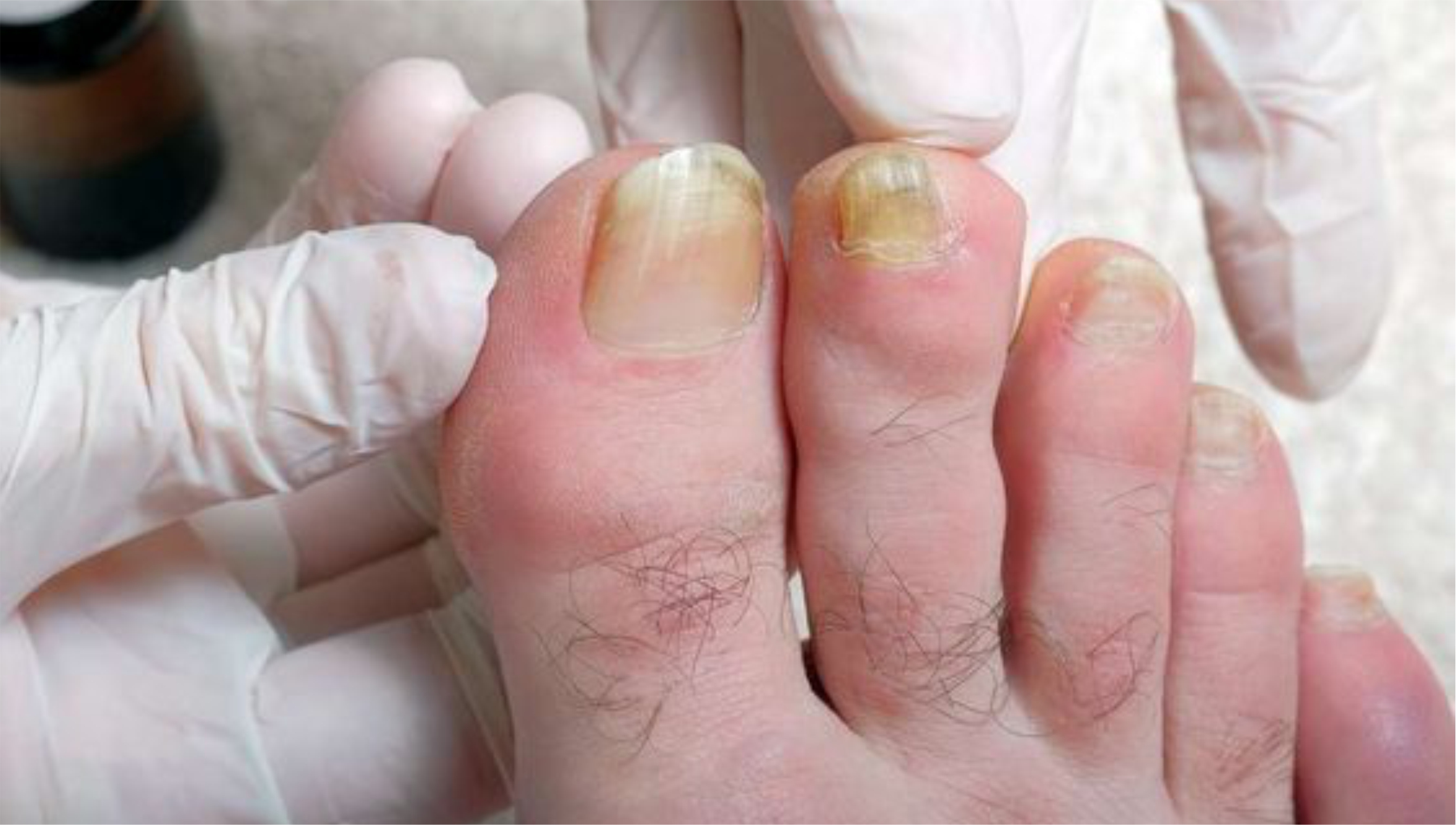 Fungal Nail Infection - South West Podiatry